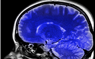 Fogginess and Forgetfulness – Do I Have a Brain Injury?