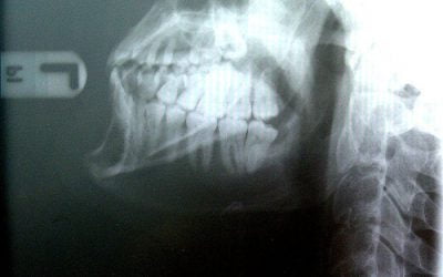Jaw Injury – Is TMJ ‘minor’? Minor Injury Regulation